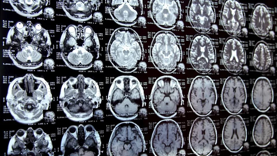 Alarm u nauci: mikroplastika u ljudskim mozgovima raste — šta to znači za zdravlje?