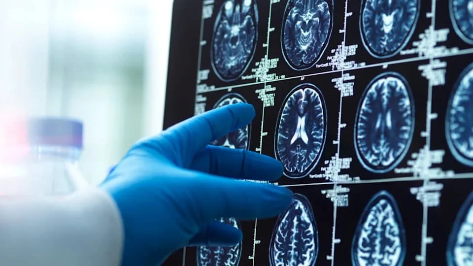 Otkriveni „staklasti“ ugrušci u mozgu — znače li mikro- i nanoplastika rizik za demenciju?