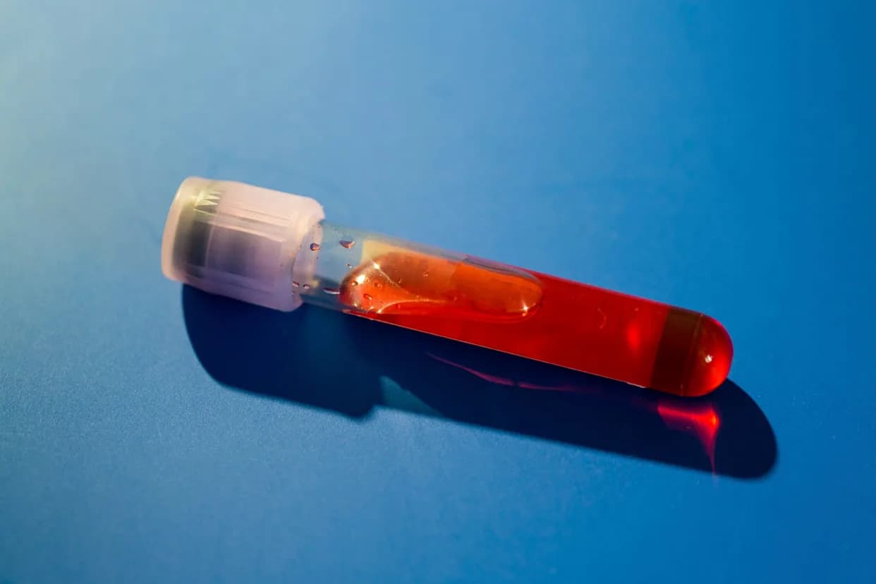 Novi krvni test prepoznaje sindrom hroničnog umora — postoji li put ka testu za long COVID?