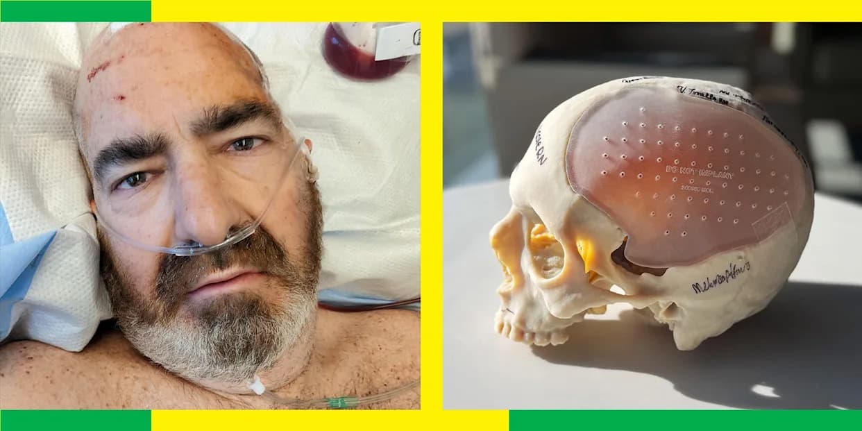Preživeo Gubitak Polovine Lobanje — Kako Je 3D‑Štampana Lobanja Spasla Život