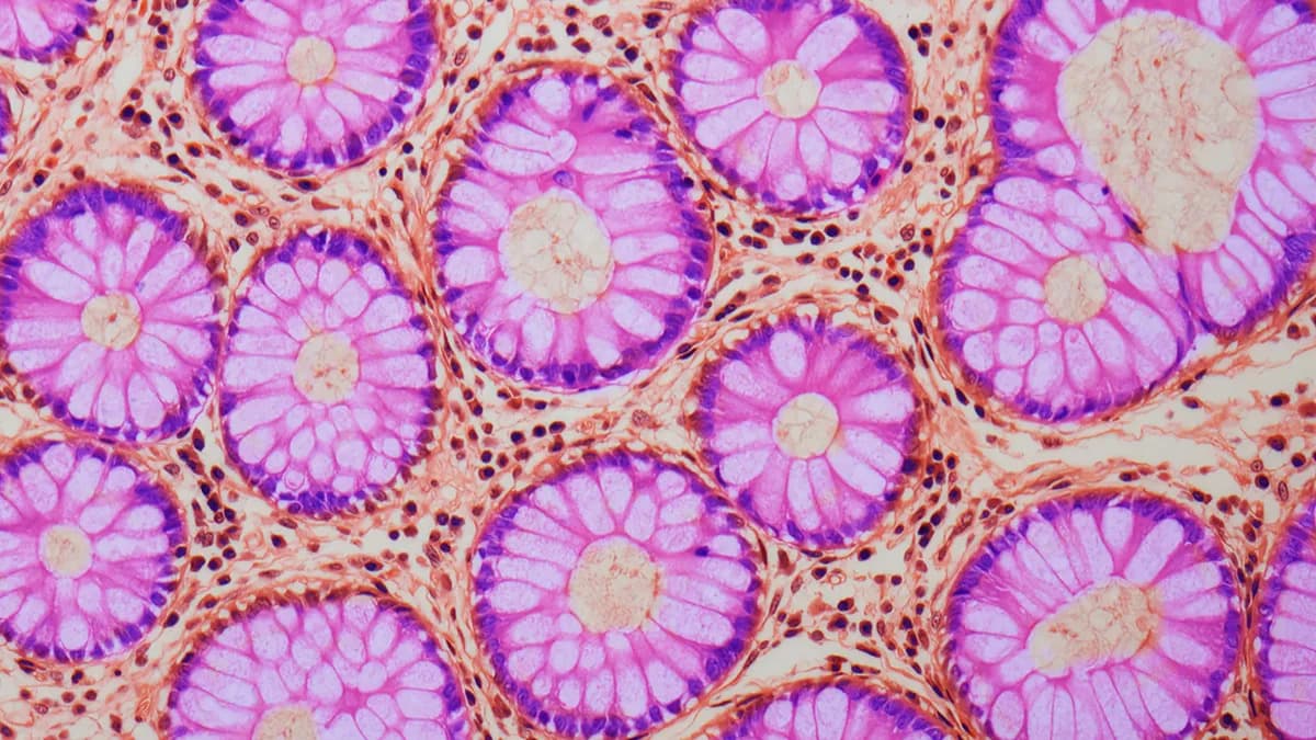 Skriveni epigenetski znak u crevima koji povećava rizik od raka debelog creva