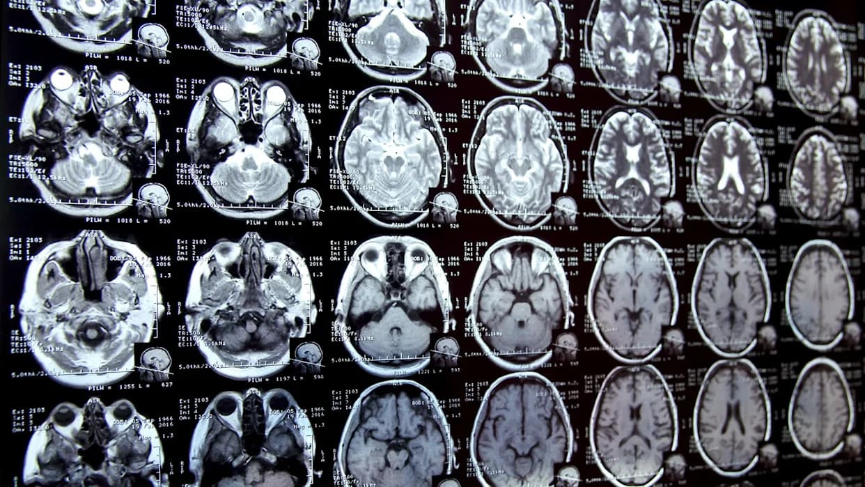 Uznemirujuće Otkrivanje: Mikroplastika U Ljudskom Mozgu Raste Eksponencijalno