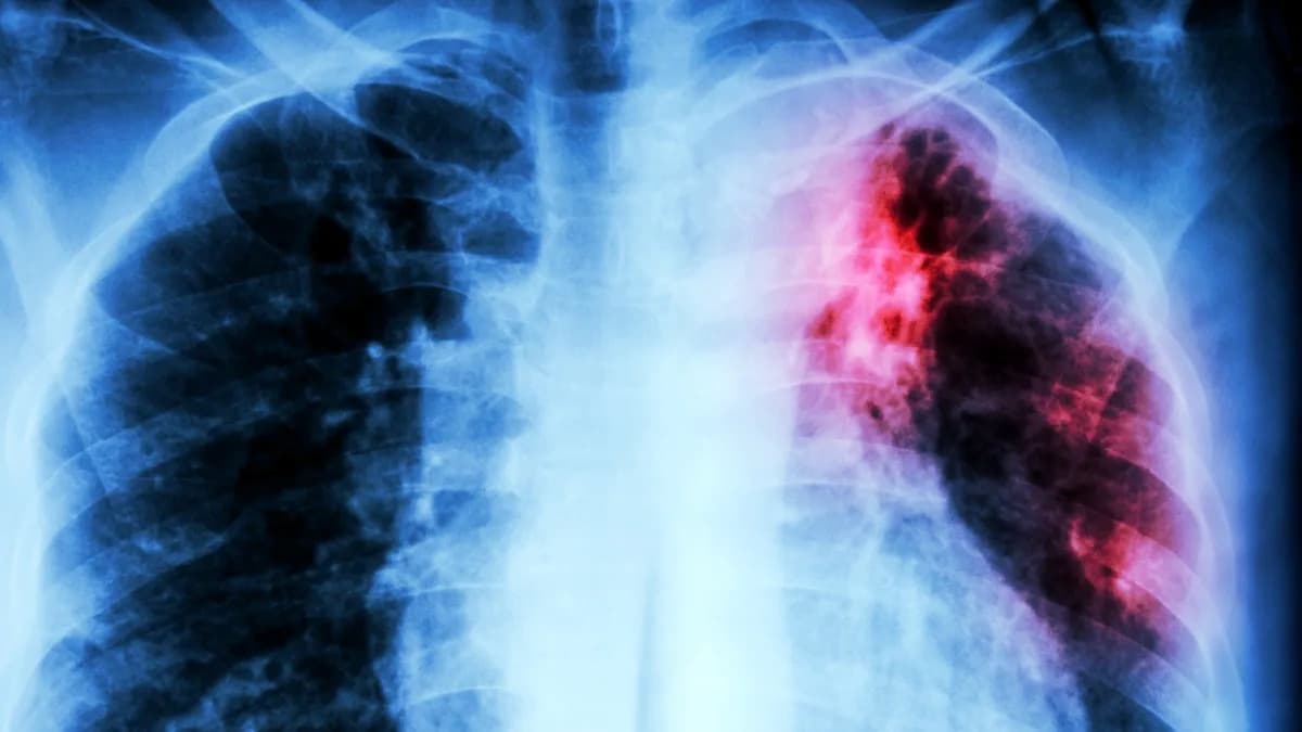 Novi trag u borbi protiv tuberkuloze: tri spoja ciljaju ključni proteinski kompleks