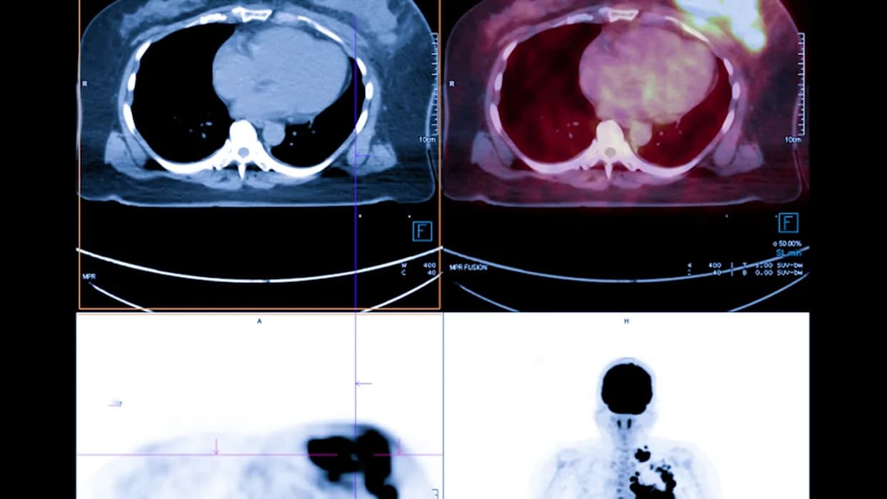 Učenica iz osmog razreda otkrila moguću vezu između mikroplastike i tumorskih struktura