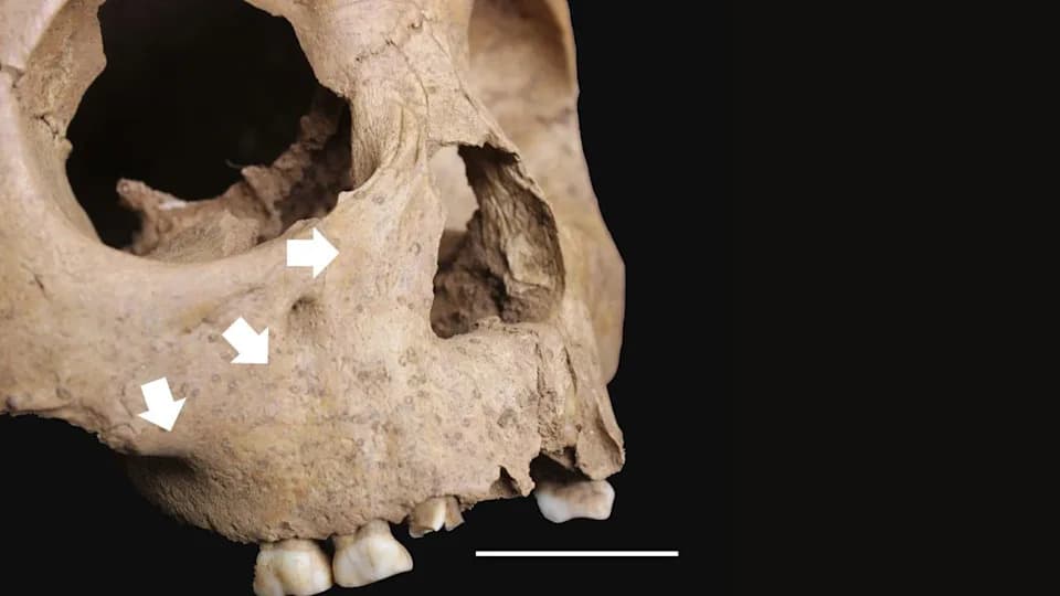 Zubi Drevne Dece Otkrivaju: Treponemska Bolest Slična Sifilisu Širila Se Vijetnamom Pre ~4.000 Godina