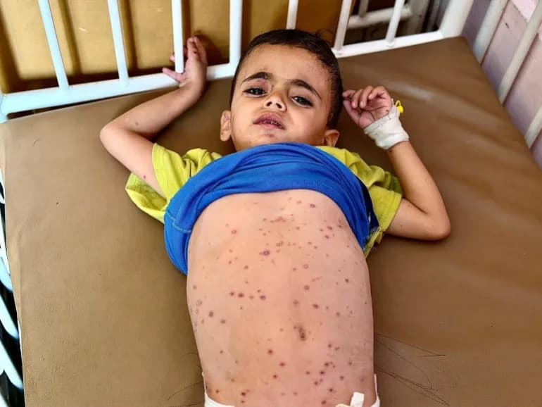 Deca Gaze Na Rubu: Talas Kožnih Bolesti Pogoršan Gladju i Nedostatkom Lekova