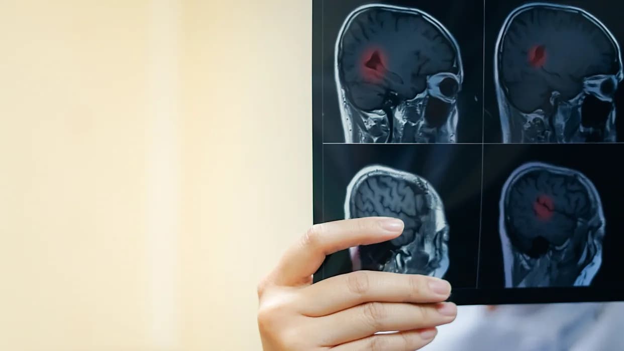 Bežični moždani implant povezuje kameru direktno s vizuelnim korteksom — ugrađen kod trećeg učesnika