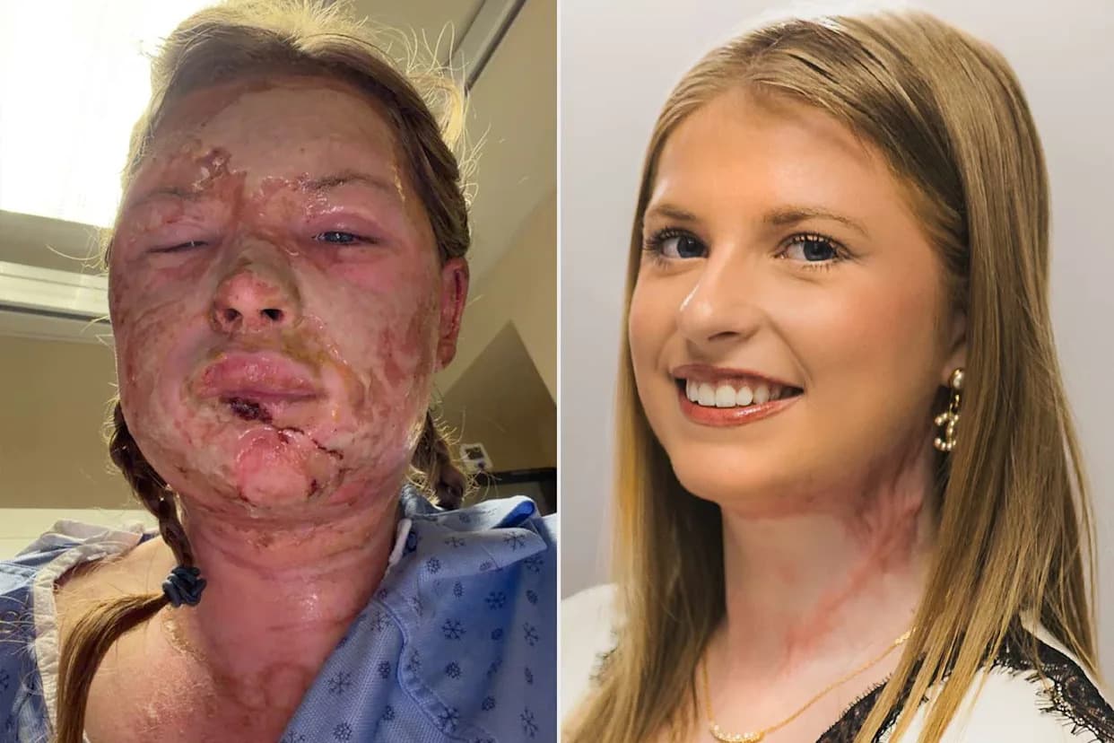 Studentkinja (18) Oporavila Se Nakon Eksperimentalne Terapije Egzomima — Prvi Takav Slučaj U Svetu