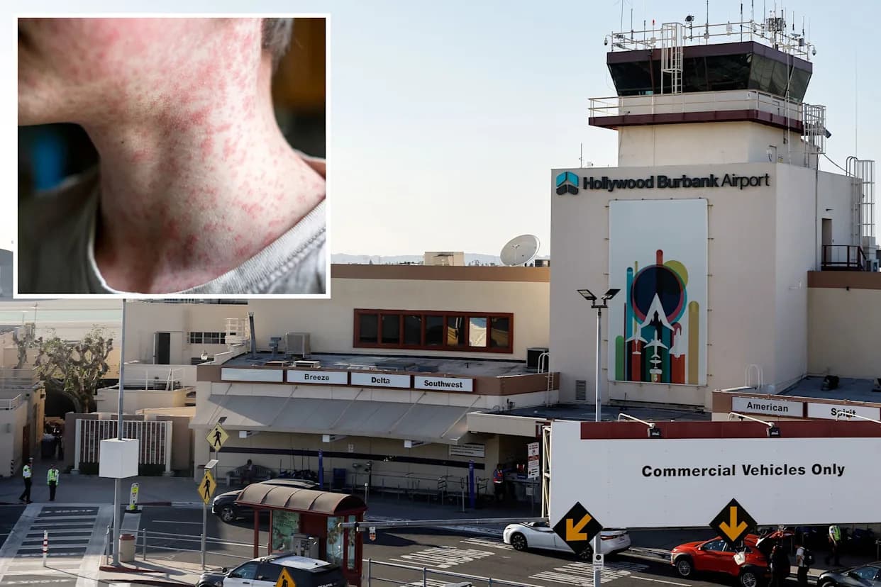 Hitno: Moguće Izlaganje Ospicama na Hollywood Burbank Aerodromu — Proverite Da Li Ste U Riziku