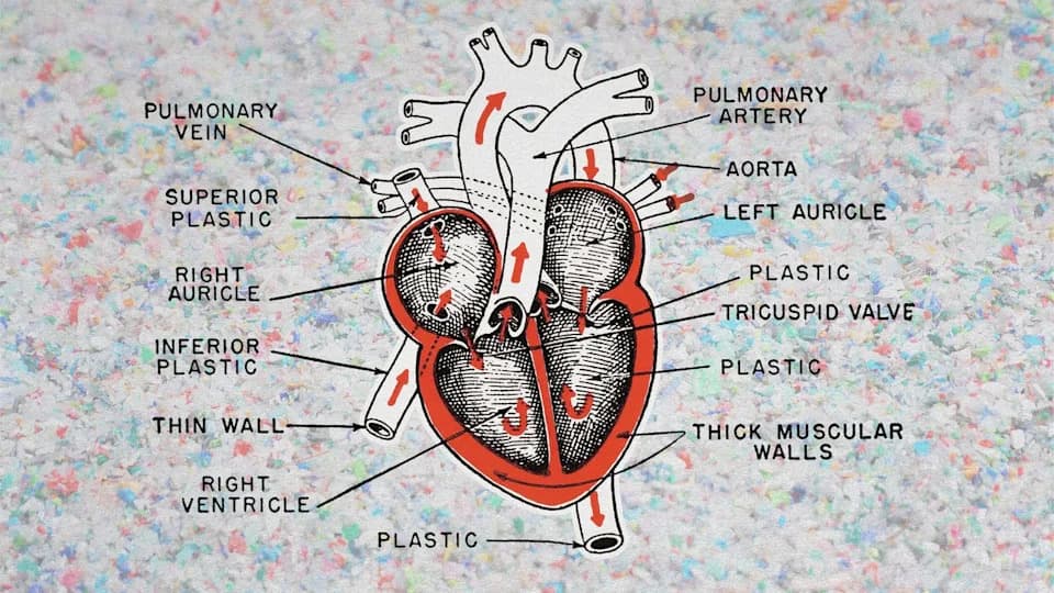 Mikroplastika i Infarkt: Nova Studija Pronalazi Plastiku U Začepljenim Arterijama