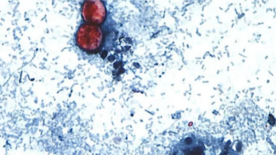 CDC: Preko 24.000 Slučajeva Ciklosporijaze — Broj Novih Infekcija Usporava, Povezano Sa Povučenom Ledenom Salatom