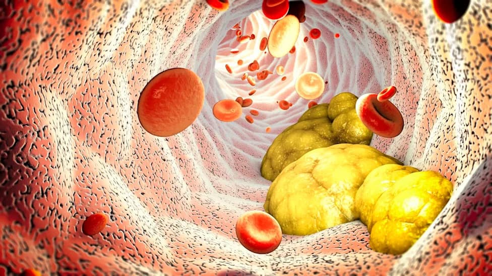 Neočekivani efekat terapijske aferesis: pad nivoa PFAS-a i mikroplastike u krvi