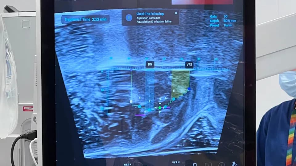 AI-podržana Aquablation: Mlaz vode vraća normalan život muškarcima sa uvećanom prostatom
