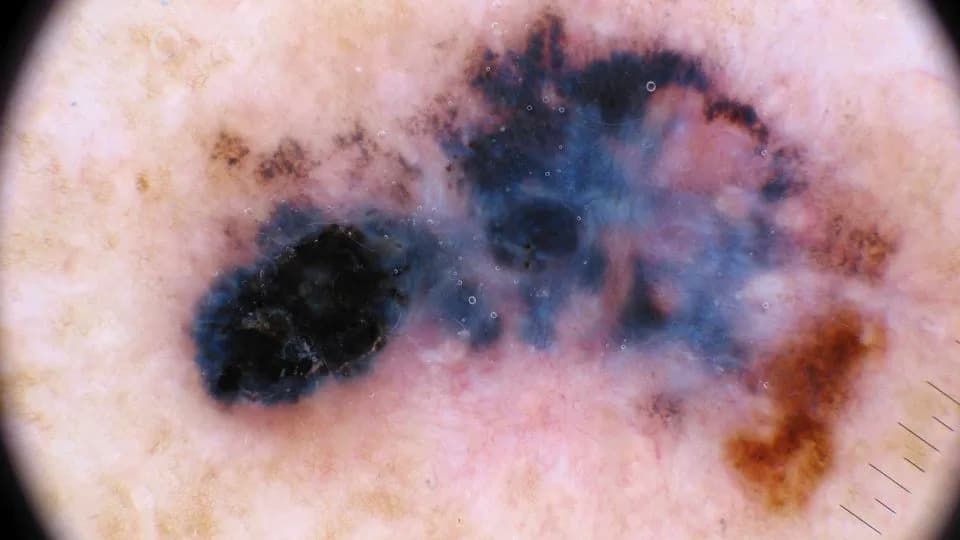 Proboj Mercka i Moderne: Personalizovana mRNA vakcina značajno smanjuje povratak i širenje melanoma