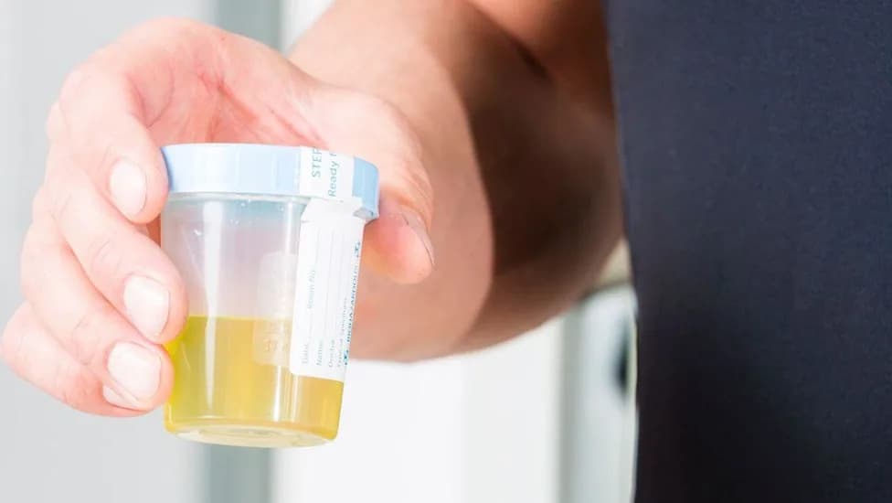 Galeas: Kućni test urina otkriva 92% slučajeva raka bešike — manje invazivna dijagnostika na pomolu