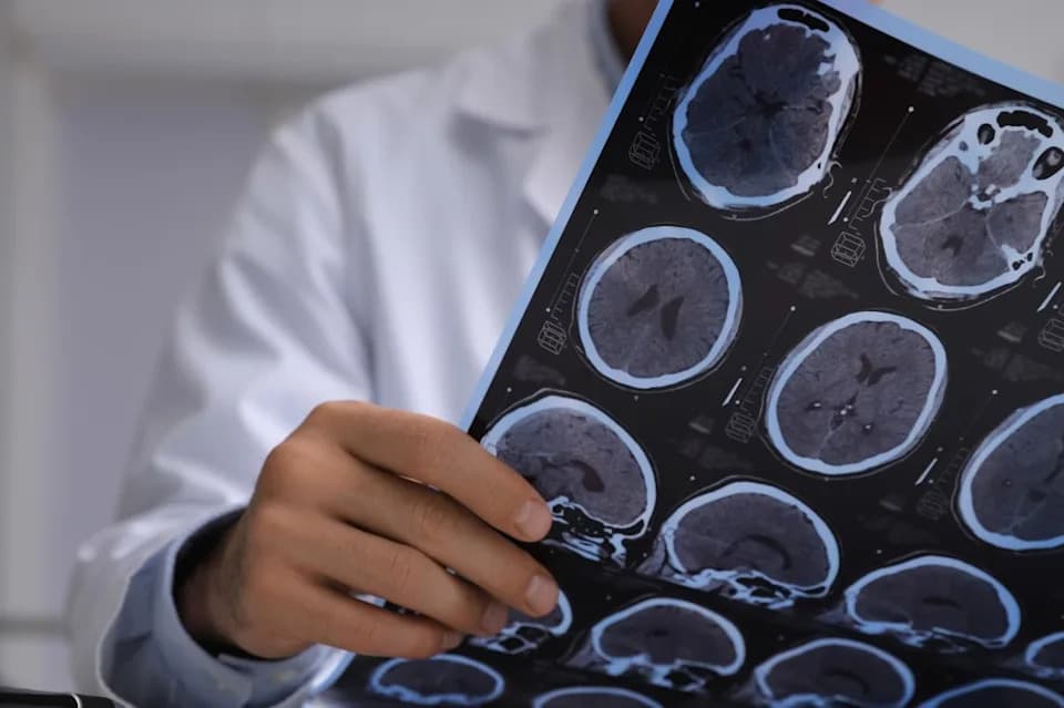 Novo istraživanje: Alchajmerova bolest može početi najmanje 7 godina pre nego što to pokažu skeneri