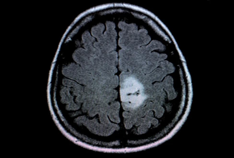 AI Može Smanjiti Potrebu Za Gadolinijumom Pri MRI: UCL Model Predviđa Pojačanje Tumora