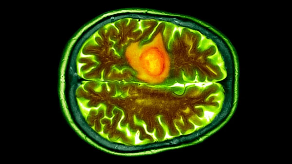 Kapi za nos koje ciljaju mozak: nanotehnologija usporava glioblastom kod miševa