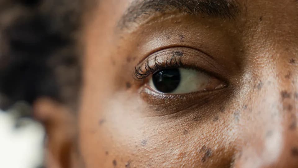 Injekcija u „lenje oko" može vratiti vid kod ambliopije kod miševa, pokazuje rana studija