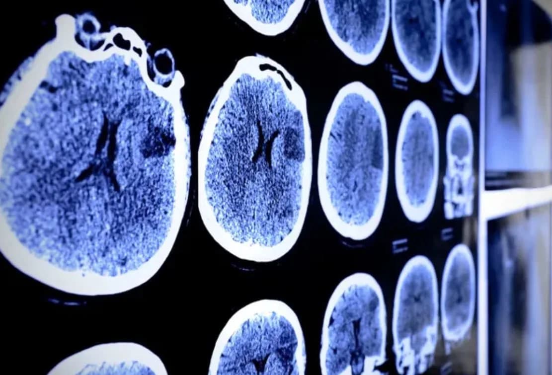 Revolucija u istraživanju udara: Transplantacija ljudskih matičnih ćelija vratila pokret miševima