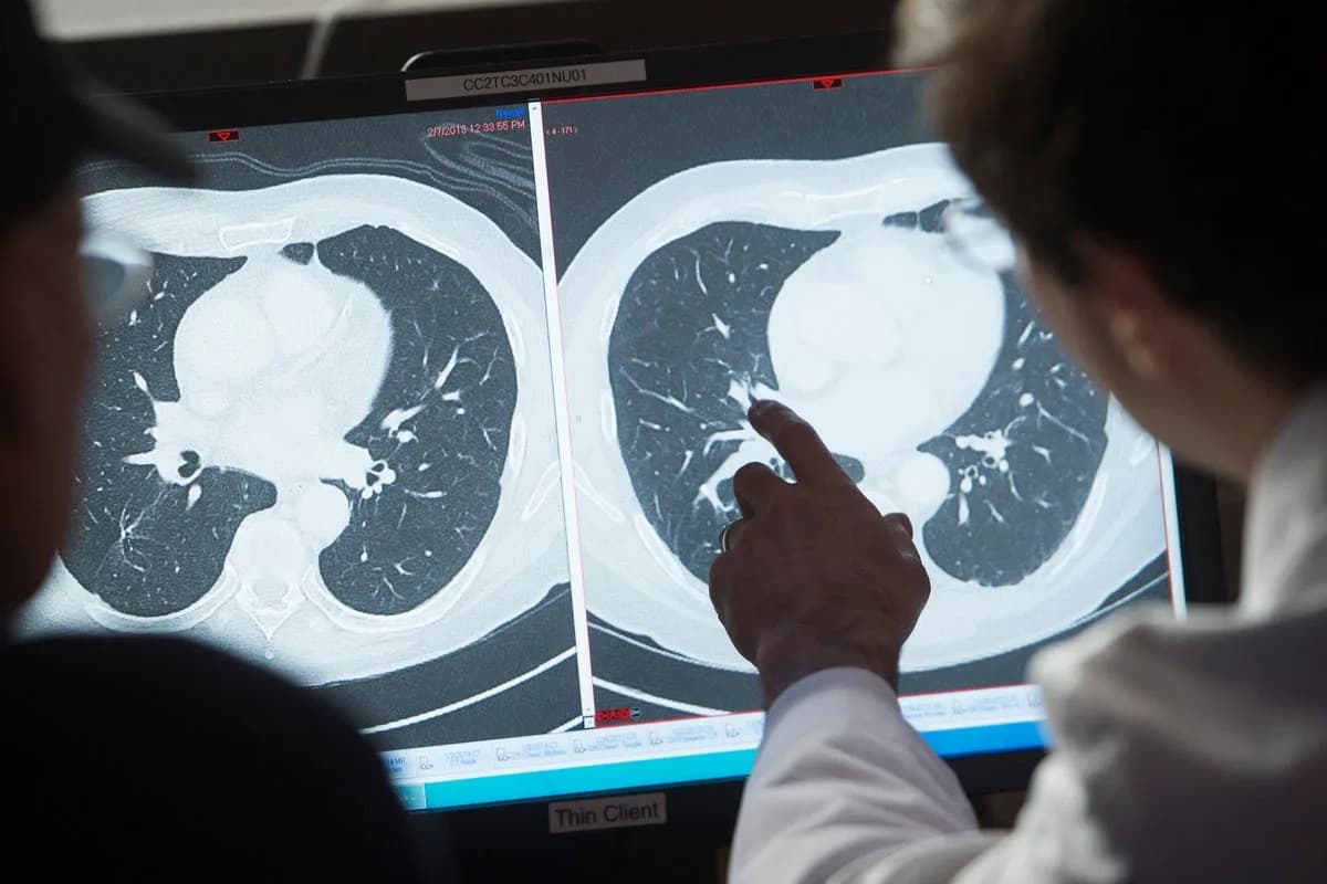 Amivantamab Može Uništiti Tumore: Potpune Remisije U Kliničkom Ispitivanju