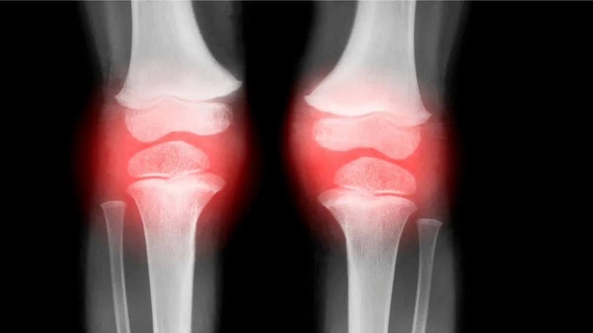 Jedna Injekcija Obnovila Zglobove Kod Životinja U 4–8 Nedelja — Terapija Se Približava Kliničkim Ispitivanjem