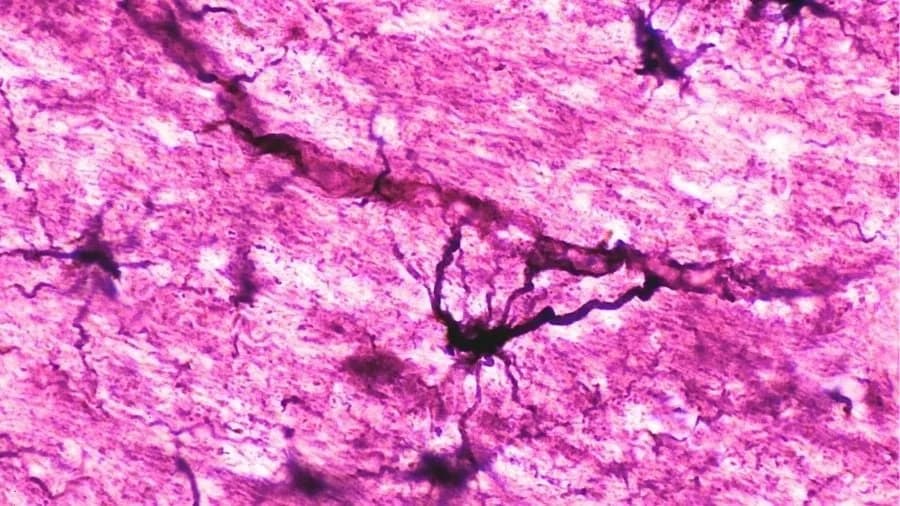 Transplantacija Donorovih Matičnih Ćelija Dovela Do 15–16 Godina Remisije Kod Dvoje Pacijenata Sa NMO