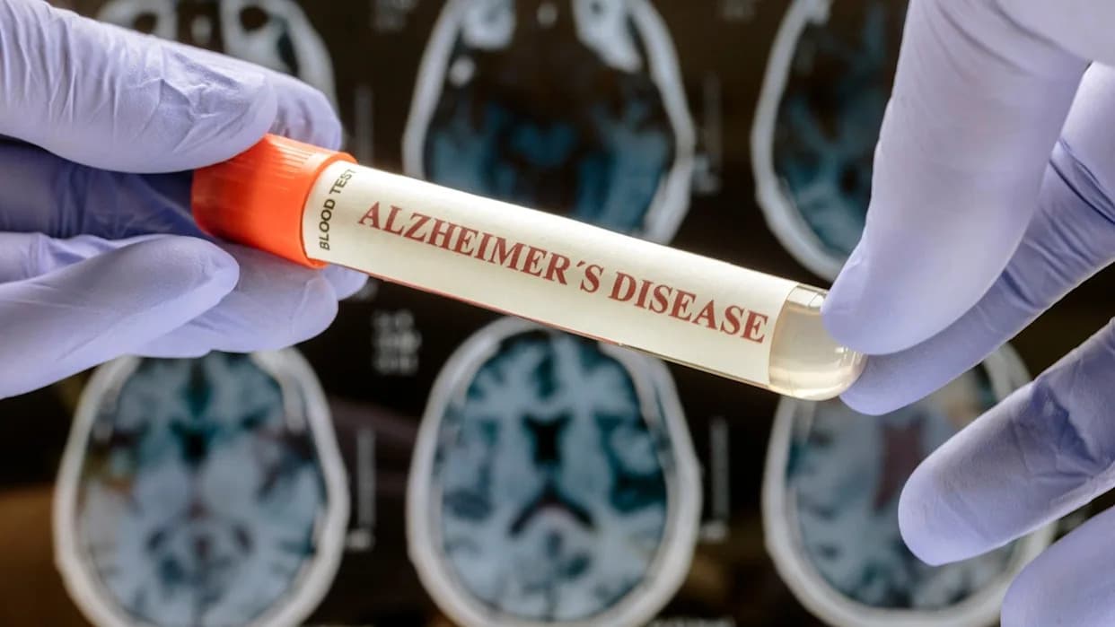 ALZAI Health Potvrdio AI Modele Za Identifikaciju Rizika Od Alchajmerove Bolesti Na 1,1M Pacijenata U SAD