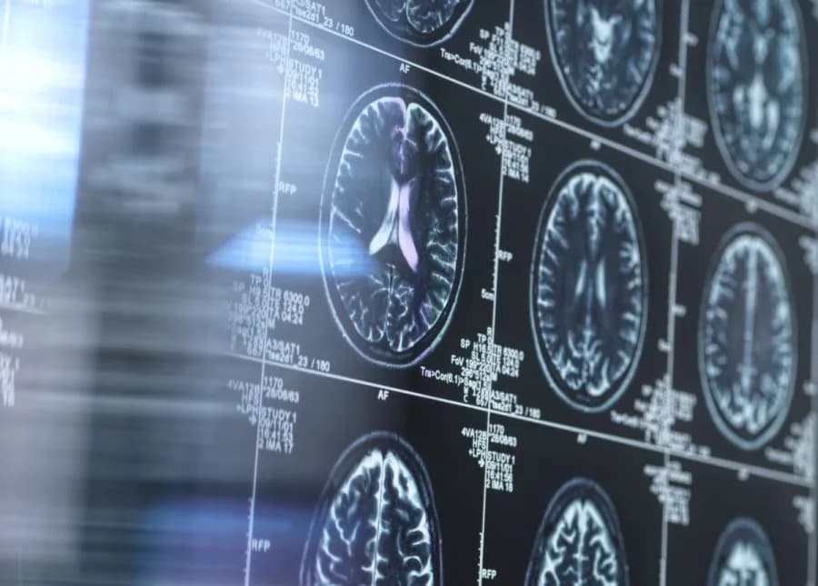 Krvni test koji može predvideti skor nastup simptoma Alchajmerove bolesti — 34 circRNA u fokusu