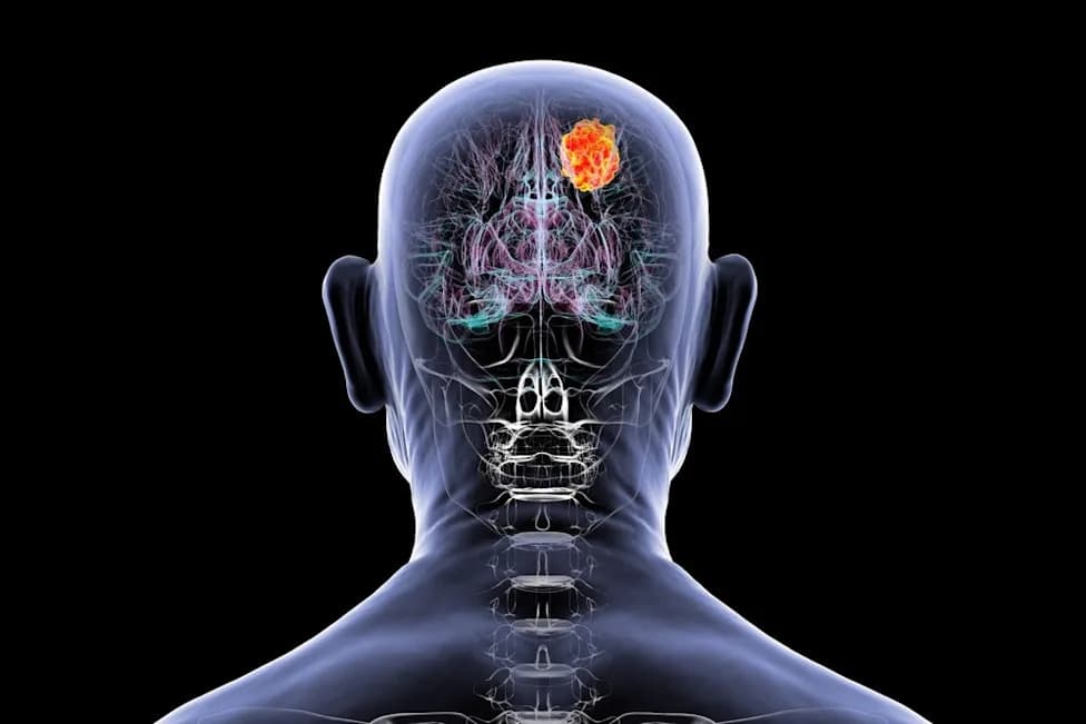 Nuvation Bio Pomera Safusidenib U Fazu III Nakon Ohrabrujućih Trogodišnjih Rezultata Kod IDH1‑Mutantnog Gradus 2 Glioma