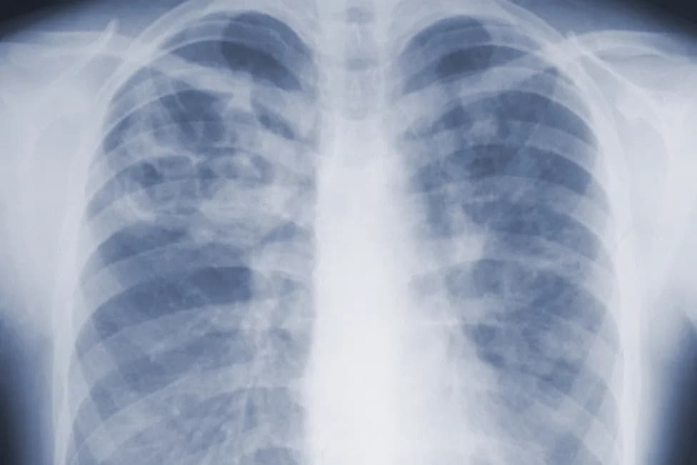 CDC Studija: Invazivne Infekcije Povezane Sa Buđi Češće I Opasnije No Što Se Mislilo