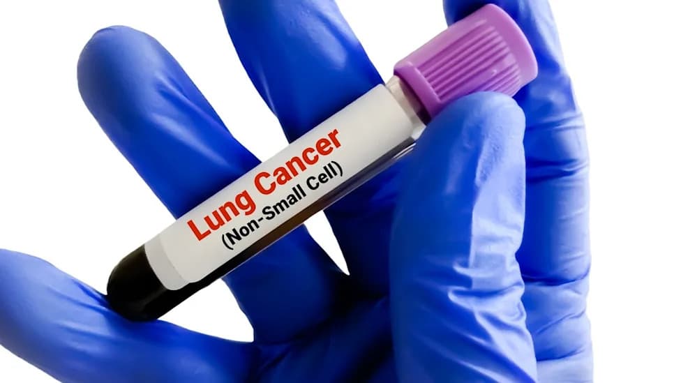 Akeso dobio NMPA odobrenje za ivonescimab + hemoterapiju kao prvi‑red za skvamozni NSCLC u Kini