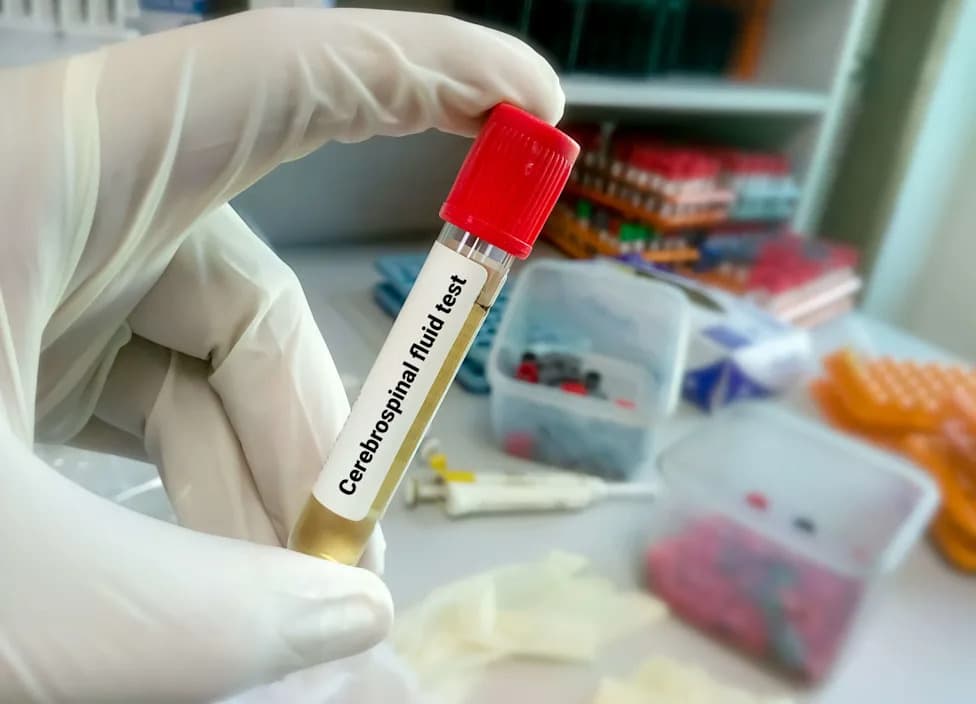 Italijanska Studija: Više Nano- i Mikroplastike U Likvoru Povezano Sa Povećanim Rizikom Za ALS