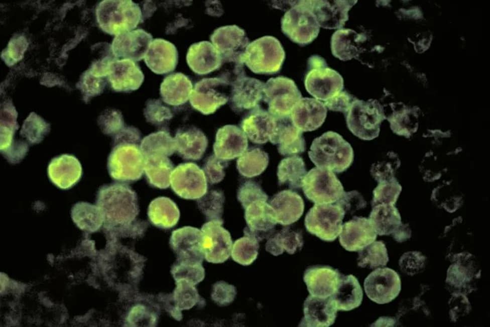 Tinejdžer Iz Severne Karoline Kritično Zbog Naegleria fowleri — Stručnjaci Upozoravaju Na Rizik U Toplim Slatkim Vodama